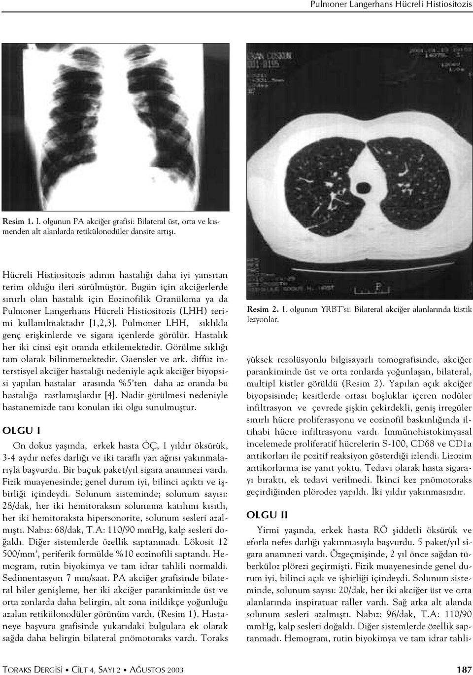 Bugün için akci erlerde s n rl olan hastal k için Eozinofilik Granüloma ya da Pulmoner Langerhans Hücreli Histiositozis (LHH) terimi kullan lmaktad r [1,2,3].