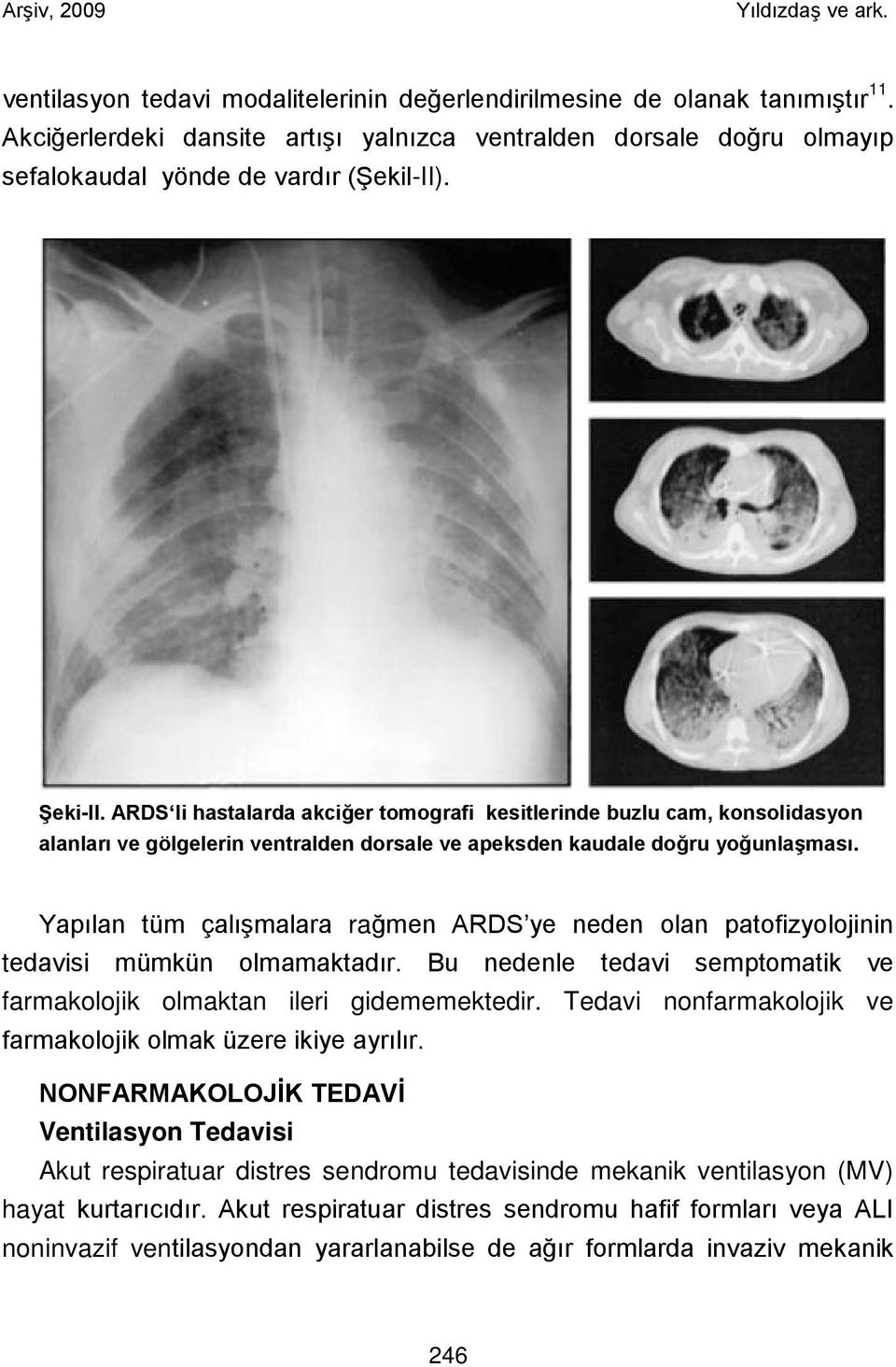 Yapılan tüm çalışmalara rağmen ARDS ye neden olan patofizyolojinin tedavisi mümkün olmamaktadır. Bu nedenle tedavi semptomatik ve farmakolojik olmaktan ileri gidememektedir.