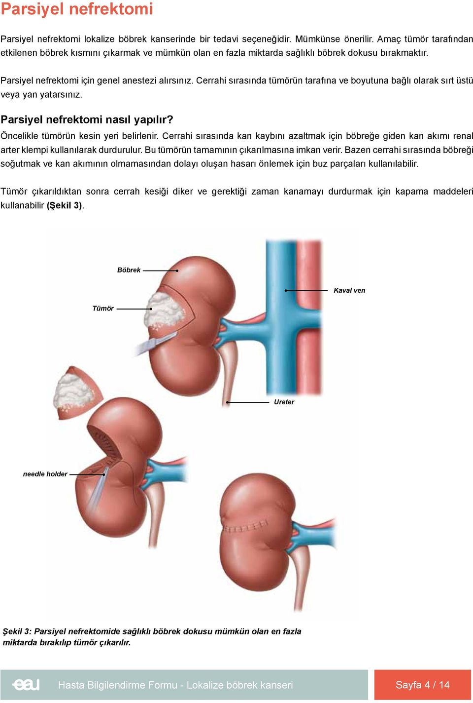 Cerrahi sırasında tümörün tarafına ve boyutuna bağlı olarak sırt üstü veya yan yatarsınız. Parsiyel nefrektomi nasıl yapılır? Öncelikle tümörün kesin yeri belirlenir.