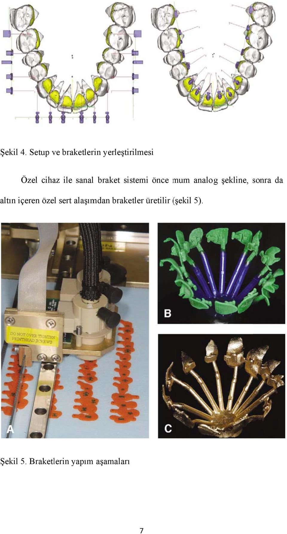 sanall braket sistemi önce mum m analogg şekline, sonra