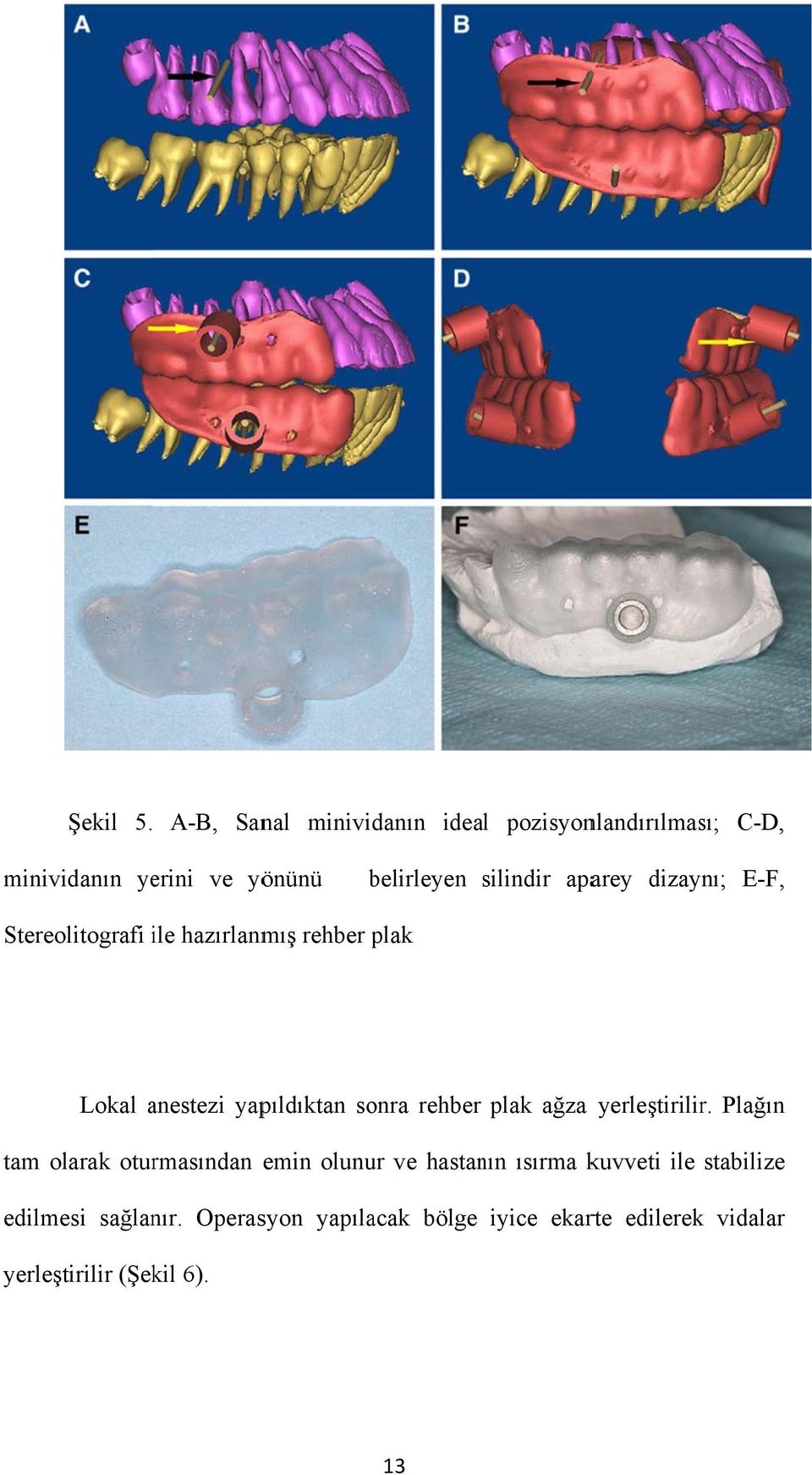 aparey dizaynı; E-F, Stereolitografi ile i hazırlanmış rehber plak Lokal anestezi yapıldıktan sonra rehber