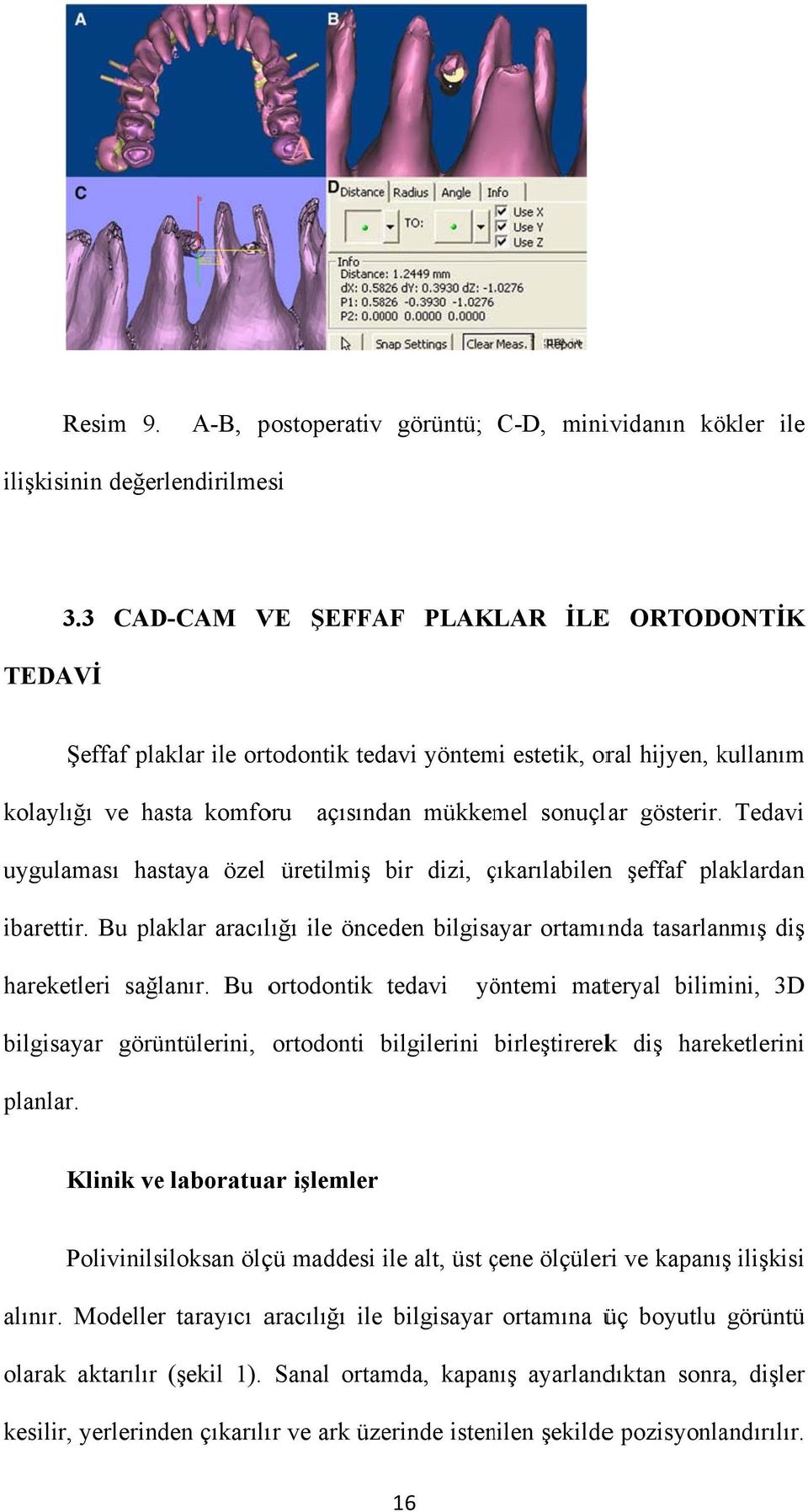 . Tedavi uygulaması hastaya özel üretilmiş bir dizi, çıkarılabilenç n şeffaf plaklardan ibarettir. Bu plaklar aracılığı ile önceden bilgisayar ortamında tasarlanmış diş hareketleri sağlanır.