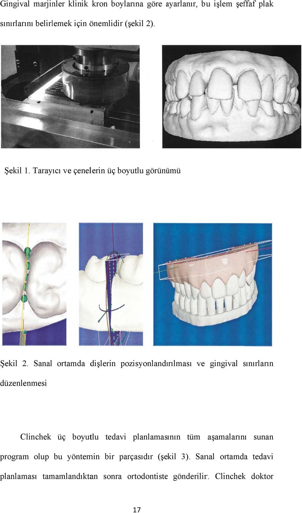 Sanal düzenlenmesi ortamda dişlerin pozisyonlandırılması ve gingival sınırların s Clinchek üç boyutlu tedavi