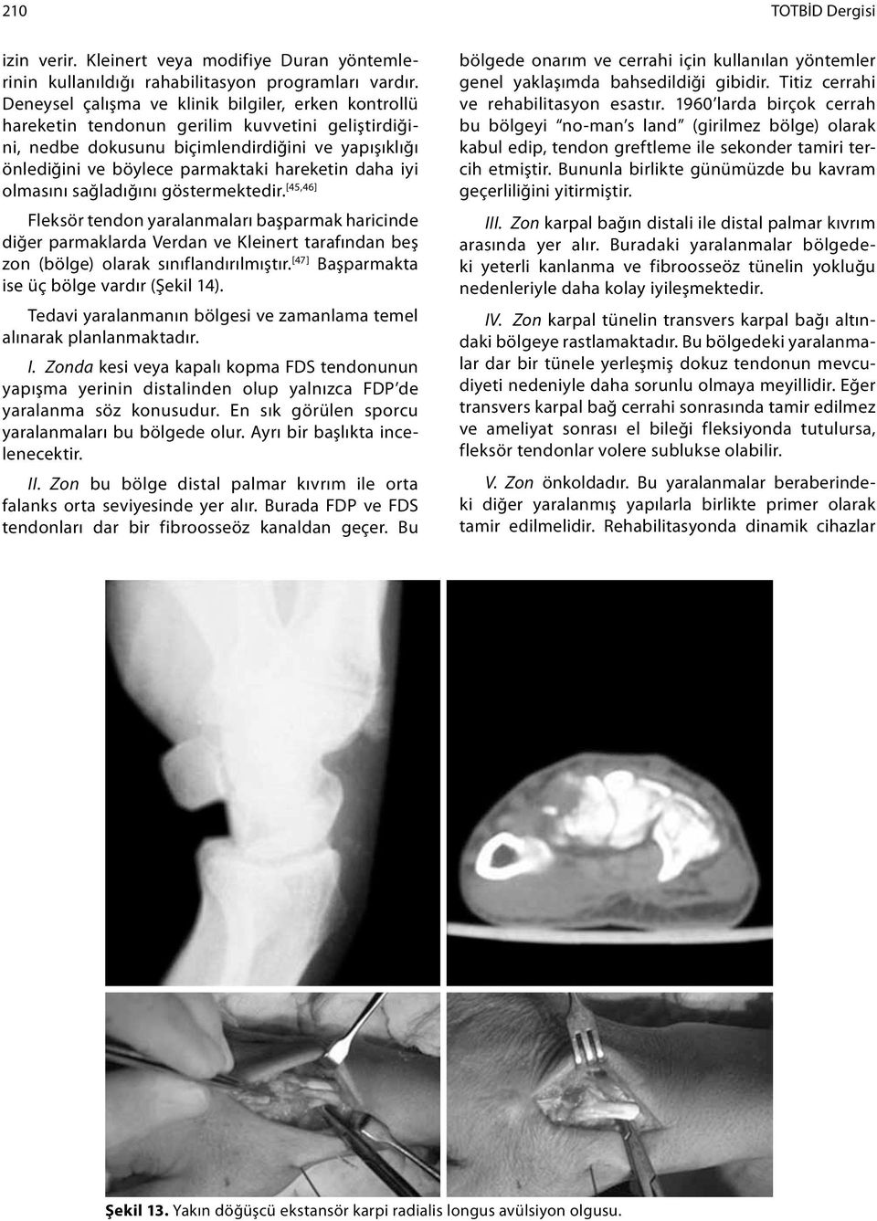 daha iyi olmasını sağladığını göstermektedir. [45,46] Fleksör tendon yaralanmaları başparmak haricinde diğer parmaklarda Verdan ve Kleinert tarafından beş zon (bölge) olarak sınıflandırılmıştır.