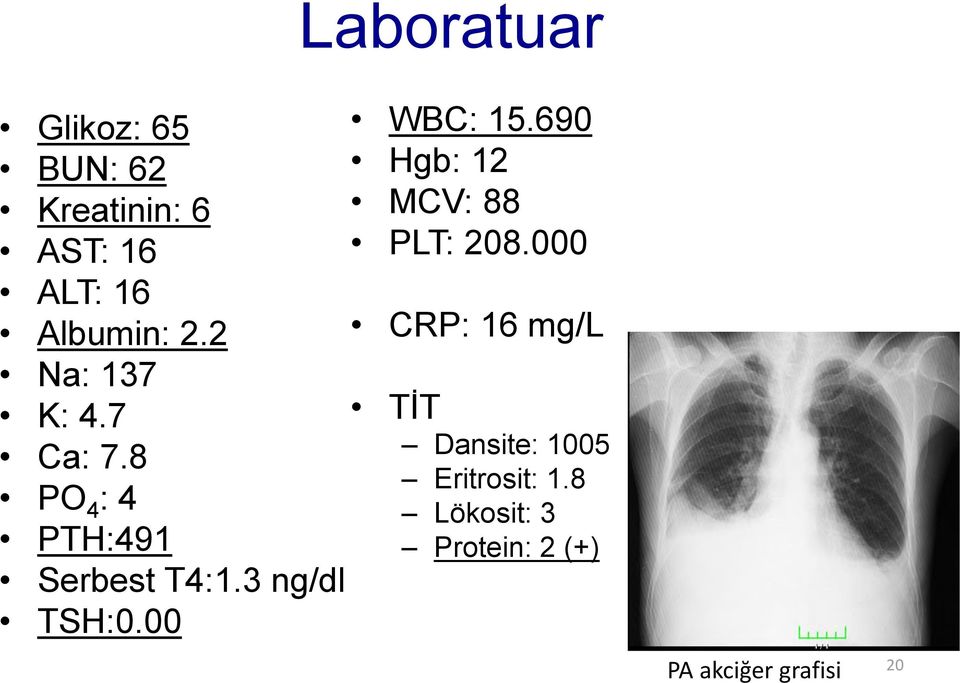 3 ng/dl TSH:0.00 WBC: 15.690 Hgb: 12 MCV: 88 PLT: 208.