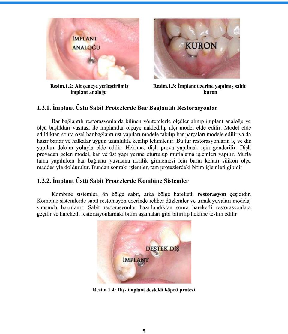 2.1. Ġmplant Üstü Sabit Protezlerde Bar Bağlantılı Restorasyonlar Bar bağlantılı restorasyonlarda bilinen yöntemlerle ölçüler alınıp implant analoğu ve ölçü baģlıkları vasıtası ile implantlar ölçüye