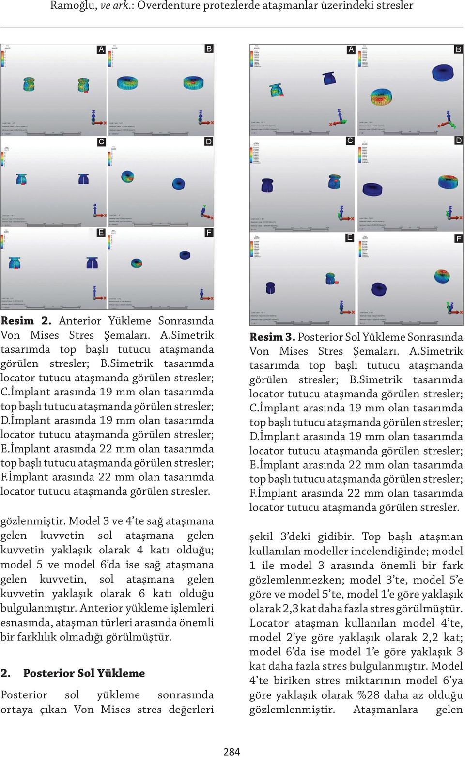 İmplant arasında 19 mm olan tasarımda locator tutucu ataşmanda görülen stresler; E.İmplant arasında 22 mm olan tasarımda top başlı tutucu ataşmanda görülen stresler; F.