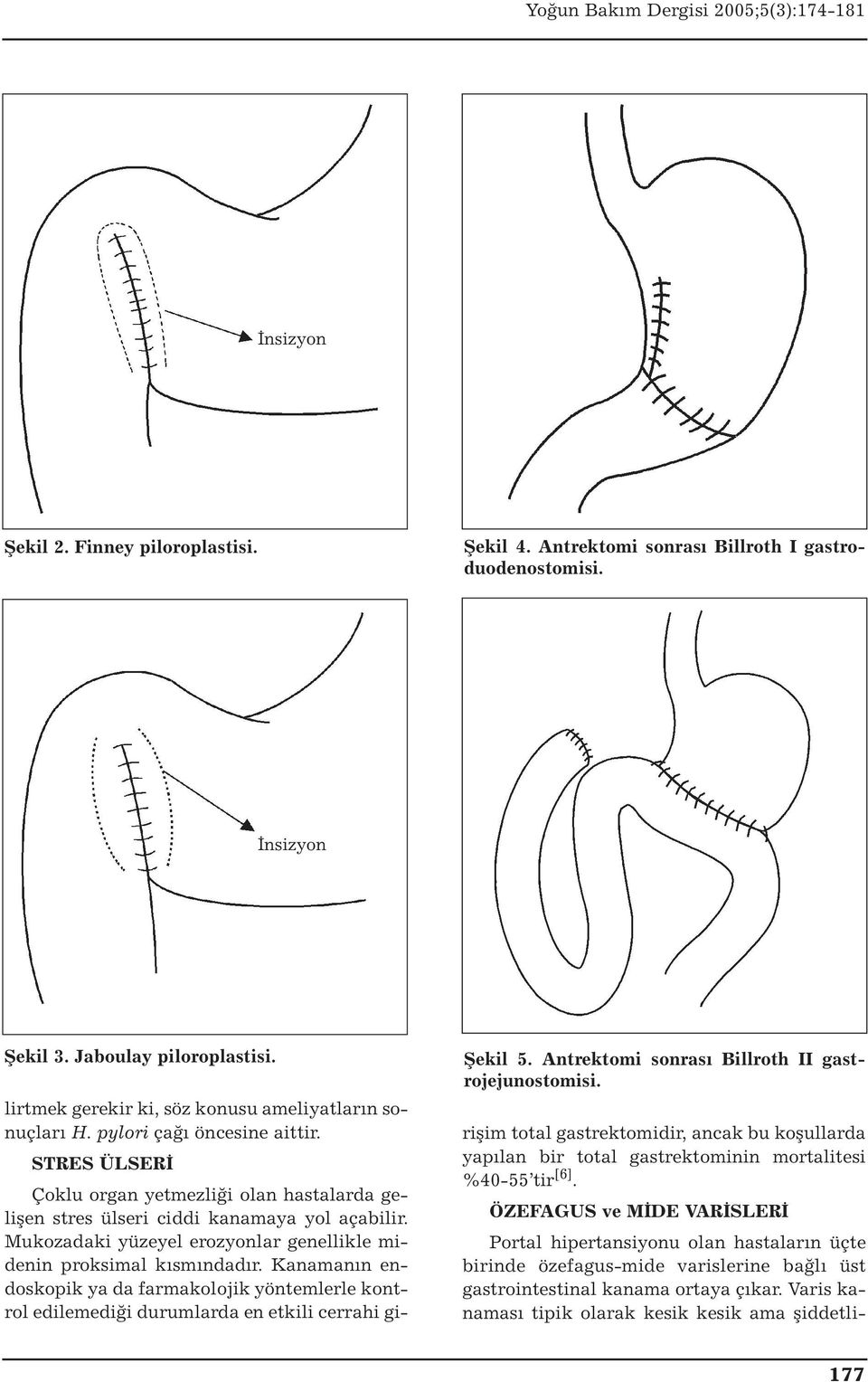 STRES ÜLSERİ Çoklu organ yetmezliği olan hastalarda gelişen stres ülseri ciddi kanamaya yol açabilir. Mukozadaki yüzeyel erozyonlar genellikle midenin proksimal kısmındadır.