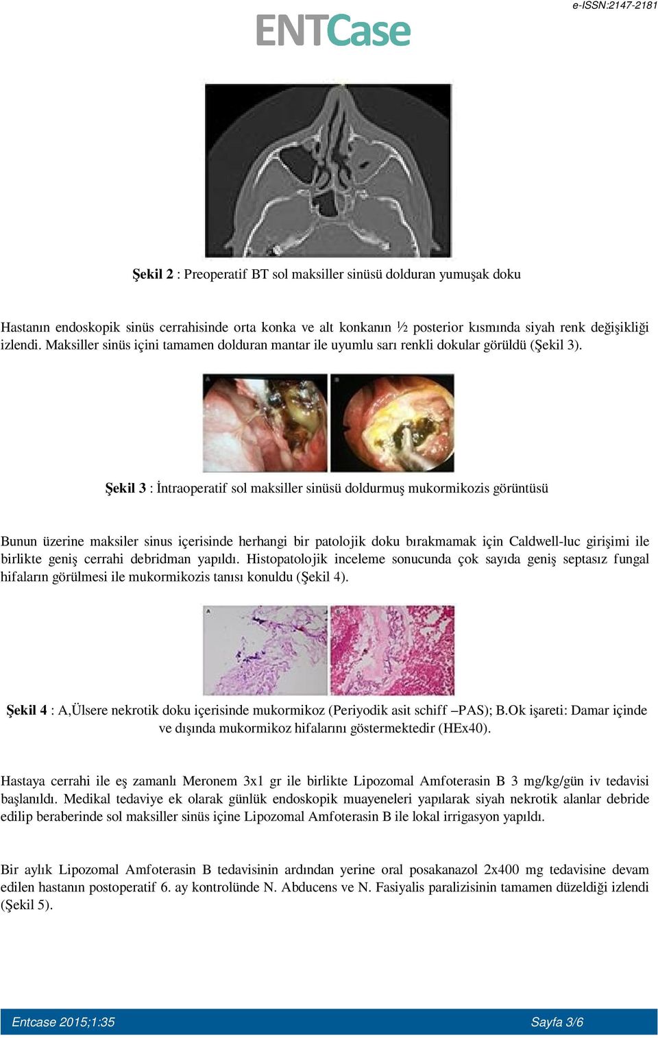 Şekil 3 : İntraoperatif sol maksiller sinüsü doldurmuş mukormikozis görüntüsü Bunun üzerine maksiler sinus içerisinde herhangi bir patolojik doku bırakmamak için Caldwell-luc girişimi ile birlikte