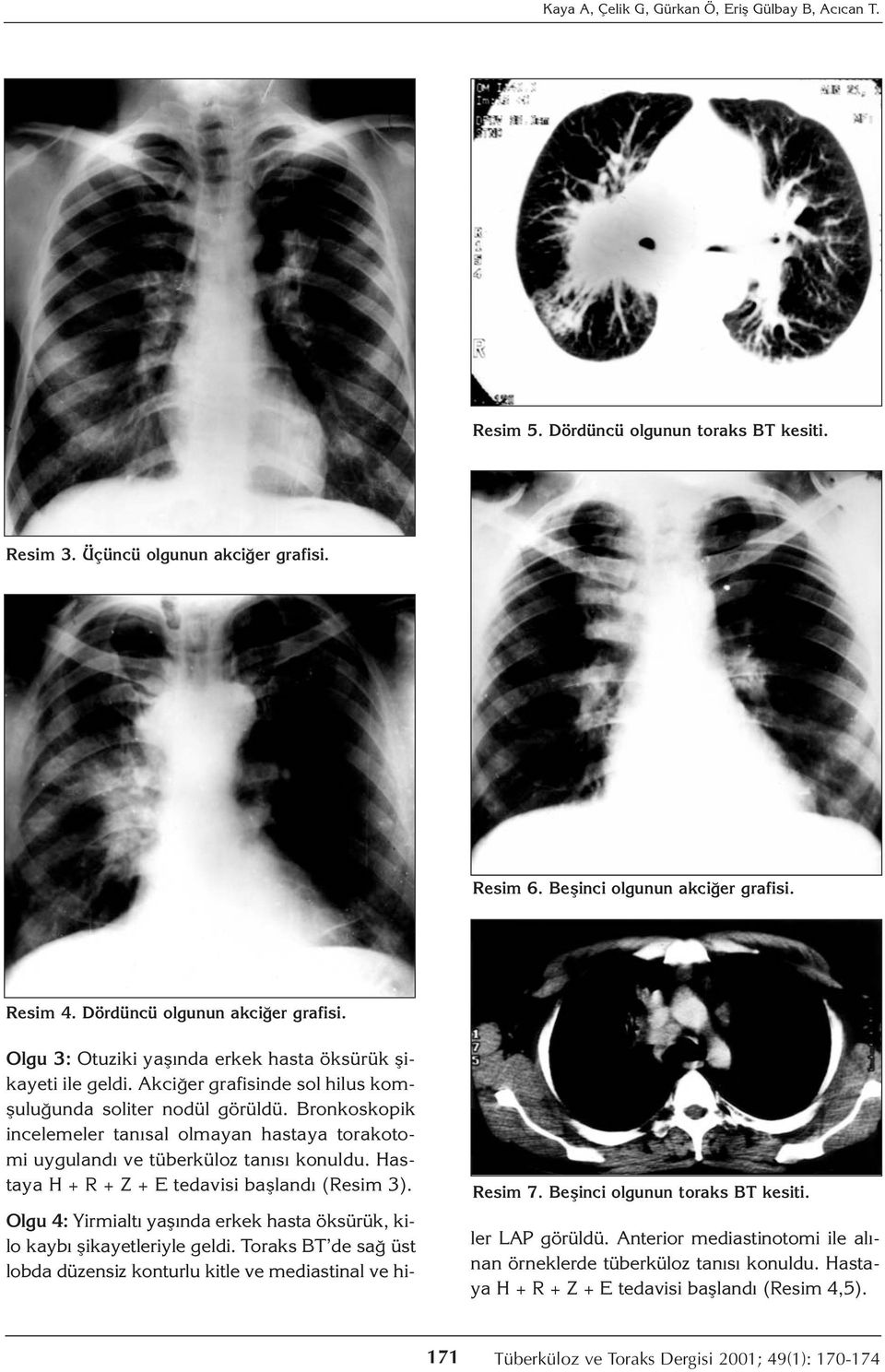Bronkoskopik incelemeler tanısal olmayan hastaya torakotomi uygulandı ve tüberküloz tanısı konuldu. Hastaya H + R + Z + E tedavisi başlandı (Resim 3). Resim 7. Beşinci olgunun toraks BT kesiti.