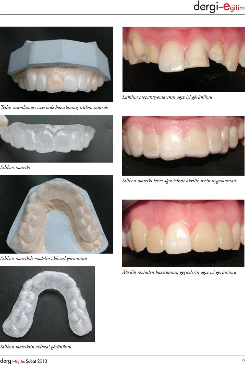 rezin uygulanması Silikon matriksli modelin okluzal görünümü Akrilik rezinden