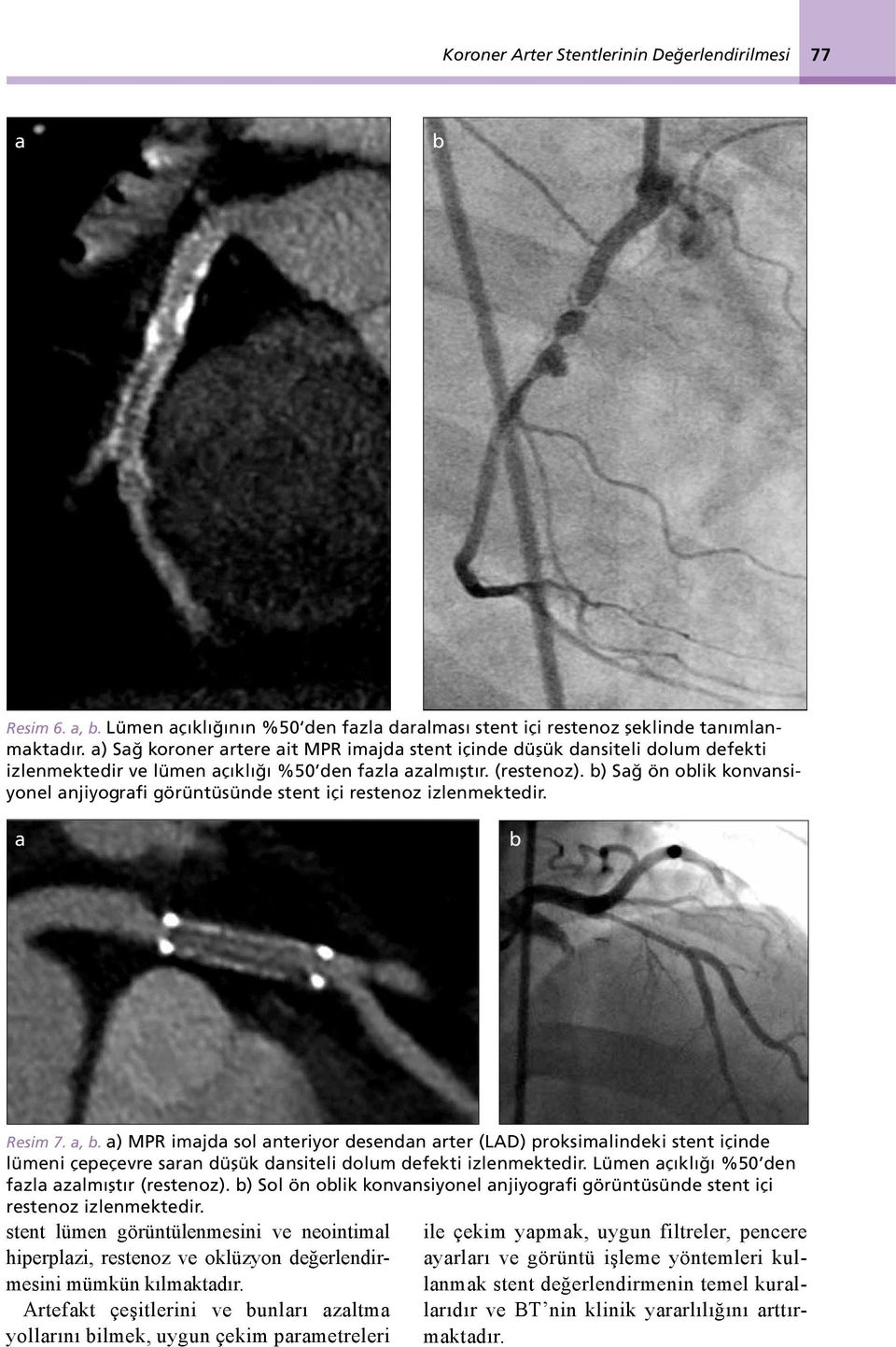 b) Sağ ön oblik konvansiyonel anjiyografi görüntüsünde stent içi restenoz izlenmektedir. a b Resim 7. a, b.