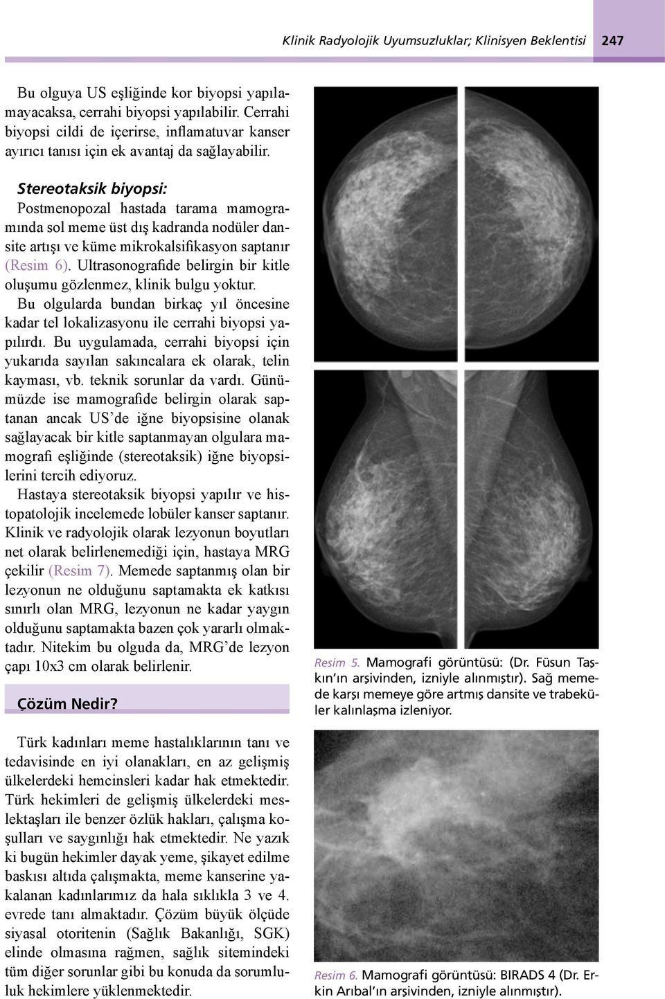 Stereotaksik biyopsi: Postmenopozal hastada tarama mamogramında sol meme üst dış kadranda nodüler dansite artışı ve küme mikrokalsifikasyon saptanır (Resim 6).