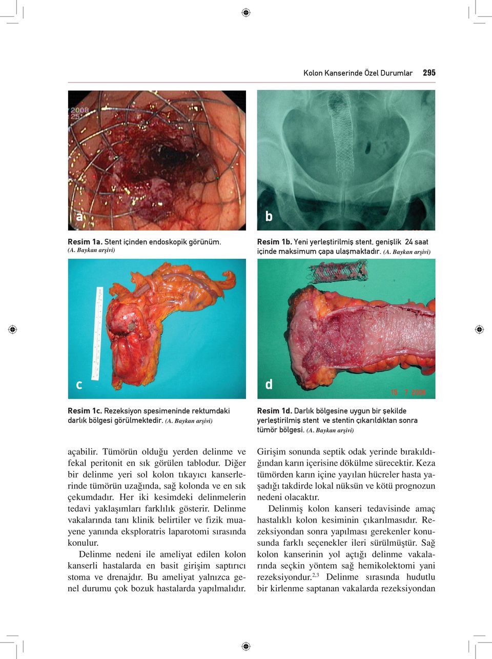 Tümörün olduğu yerden delinme ve fekal peritonit en sık görülen tablodur. Diğer bir delinme yeri sol kolon tıkayıcı kanserlerinde tümörün uzağında, sağ kolonda ve en sık çekumdadır.