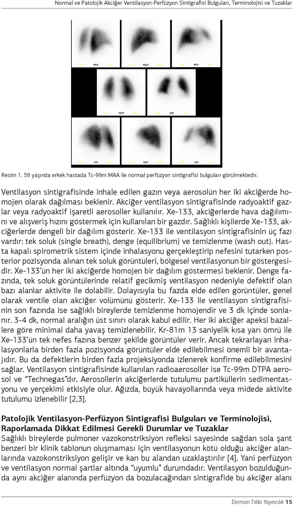 Akciğer ventilasyon sintigrafisinde radyoaktif gazlar veya radyoaktif işaretli aerosoller kullanılır. Xe-133, akciğerlerde hava dağılımını ve alışveriş hızını göstermek için kullanılan bir gazdır.