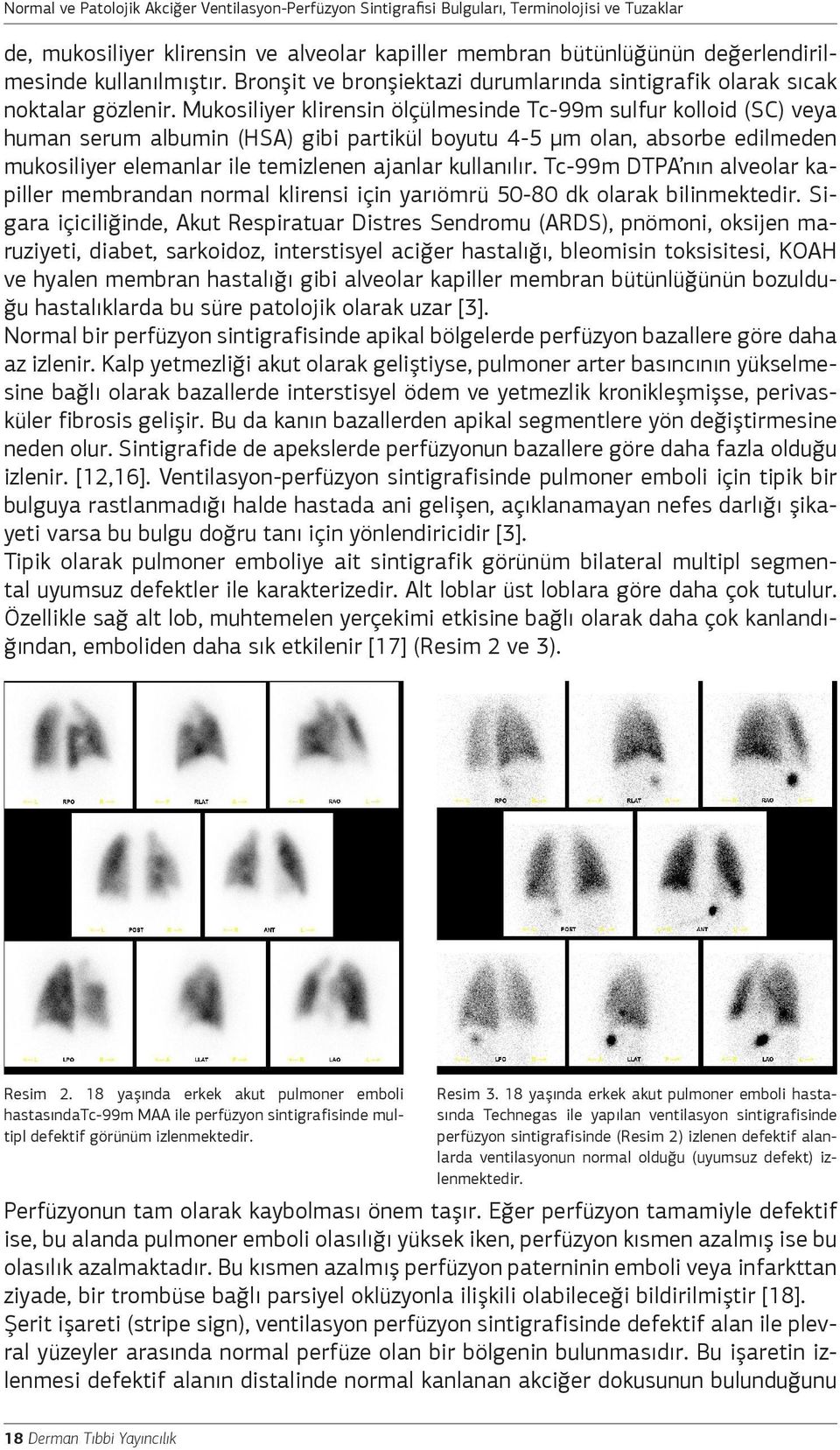 kullanılır. Tc-99m DTPA nın alveolar kapiller membrandan normal klirensi için yarıömrü 50-80 dk olarak bilinmektedir.