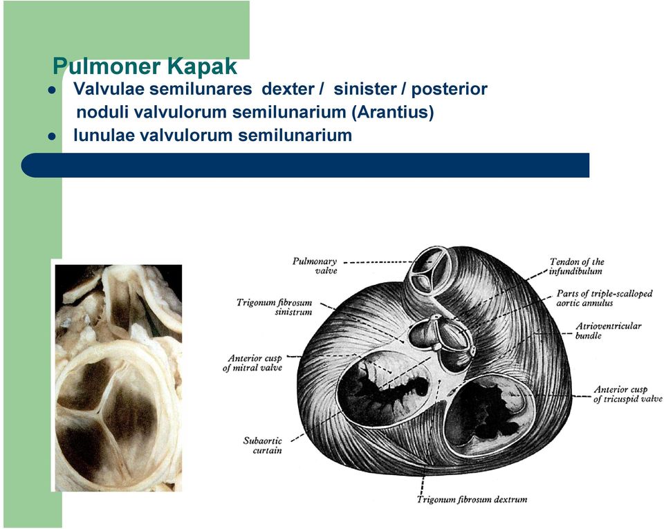 posterior noduli valvulorum