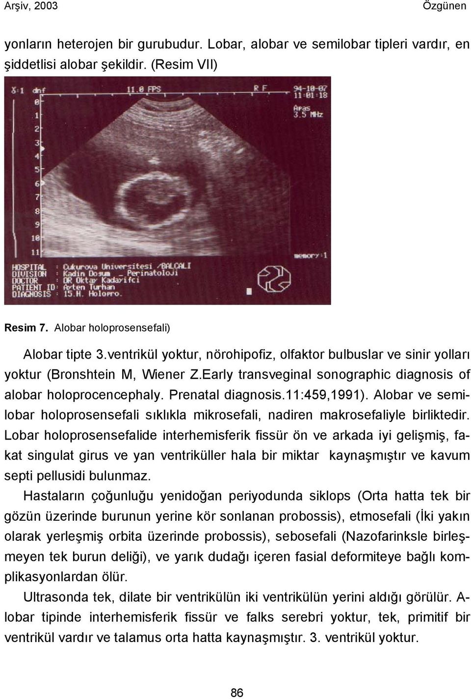 Alobar ve semilobar holoprosensefali sıklıkla mikrosefali, nadiren makrosefaliyle birliktedir.