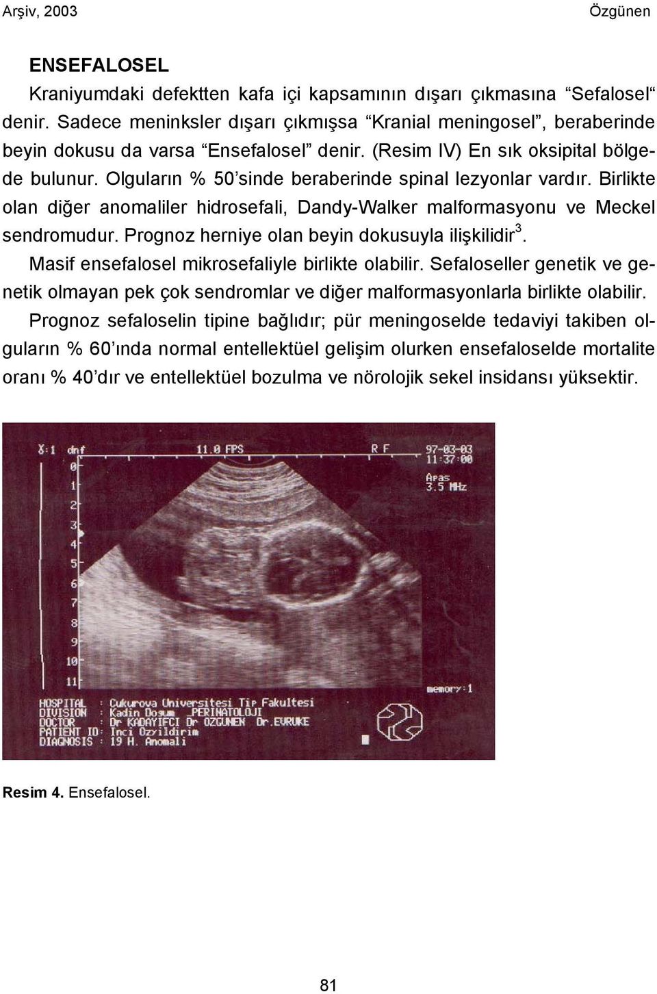 Prognoz herniye olan beyin dokusuyla ilişkilidir 3. Masif ensefalosel mikrosefaliyle birlikte olabilir.