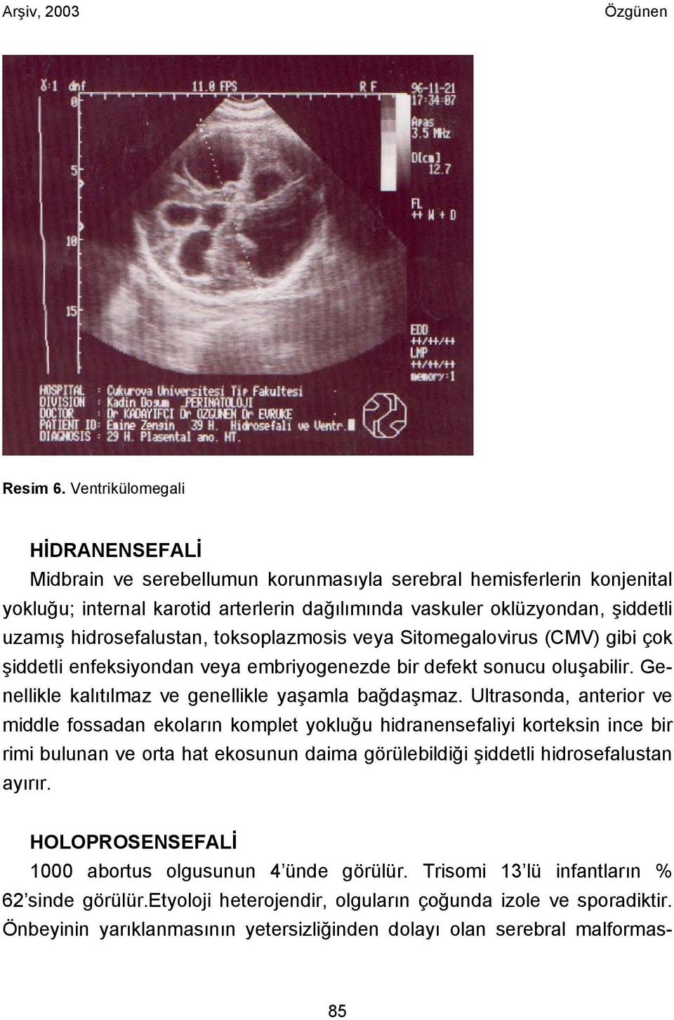 hidrosefalustan, toksoplazmosis veya Sitomegalovirus (CMV) gibi çok şiddetli enfeksiyondan veya embriyogenezde bir defekt sonucu oluşabilir. Genellikle kalıtılmaz ve genellikle yaşamla bağdaşmaz.