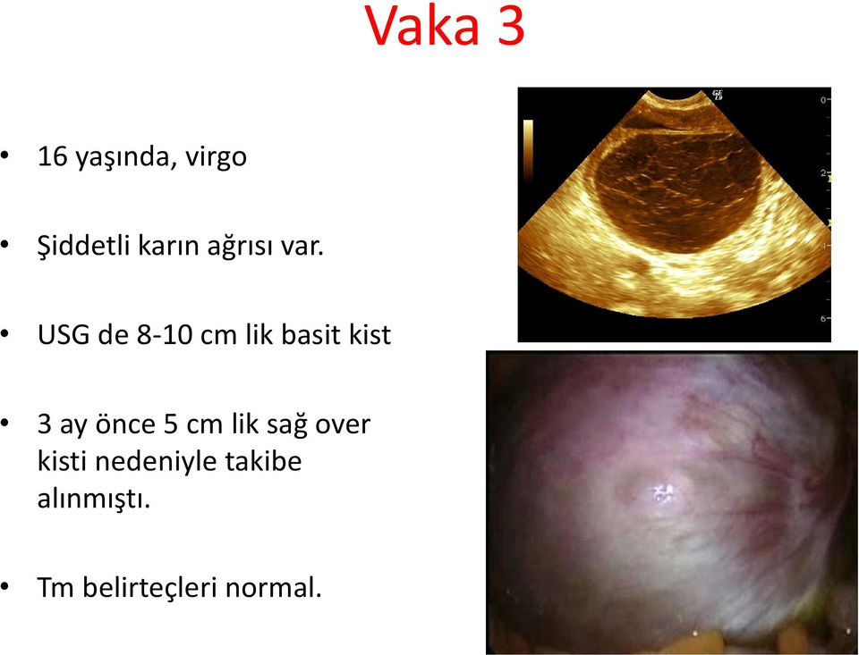 USG de 8-10 cm lik basit kist 3 ay önce 5