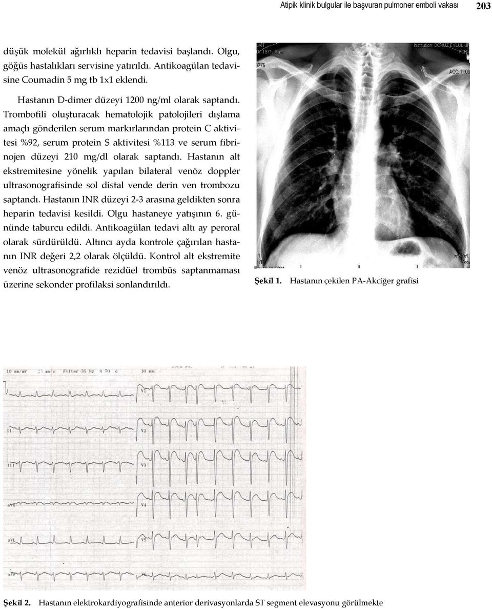 Trombofili oluşturacak hematolojik patolojileri dışlama amaçlı gönderilen serum markırlarından protein C aktivitesi %92, serum protein S aktivitesi %113 ve serum fibrinojen düzeyi 210 mg/dl olarak