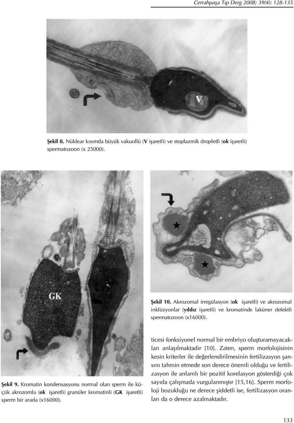 Kromatin kondensasyonu normal olan sperm ile küçük akrozomlu (ok iflaretli) granüler kromatinli (GK iflaretli) sperm bir arada (x16000).