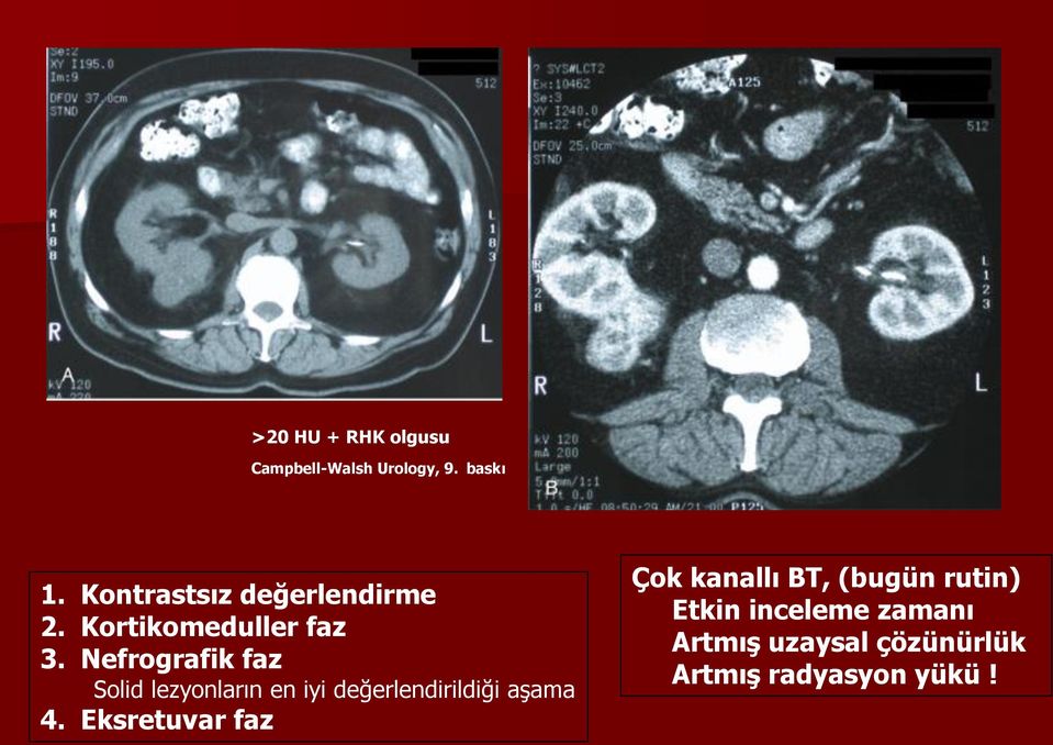 Nefrografik faz Solid lezyonların en iyi değerlendirildiği aşama 4.