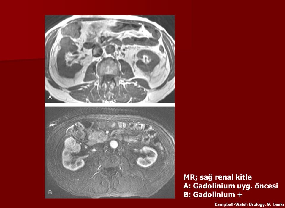 öncesi B: Gadolinium +