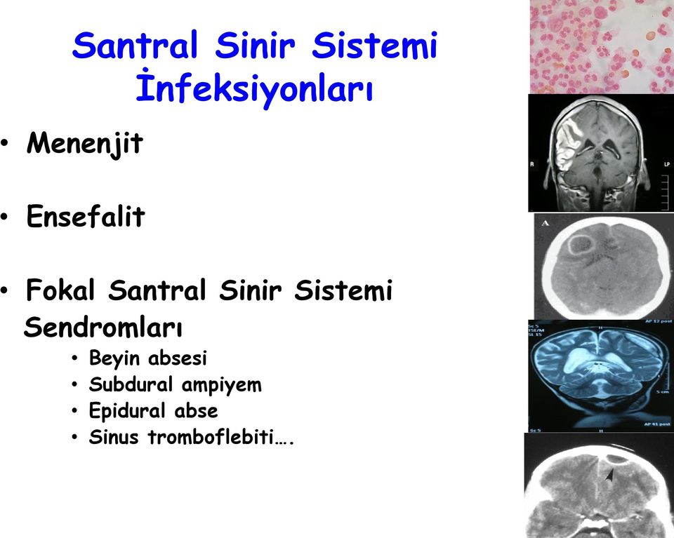 Sinir Sistemi Sendromları Beyin absesi