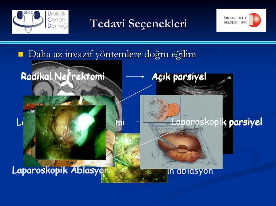 Nefrektomi Açık parsiyel Laparoskopik Nefrektomi