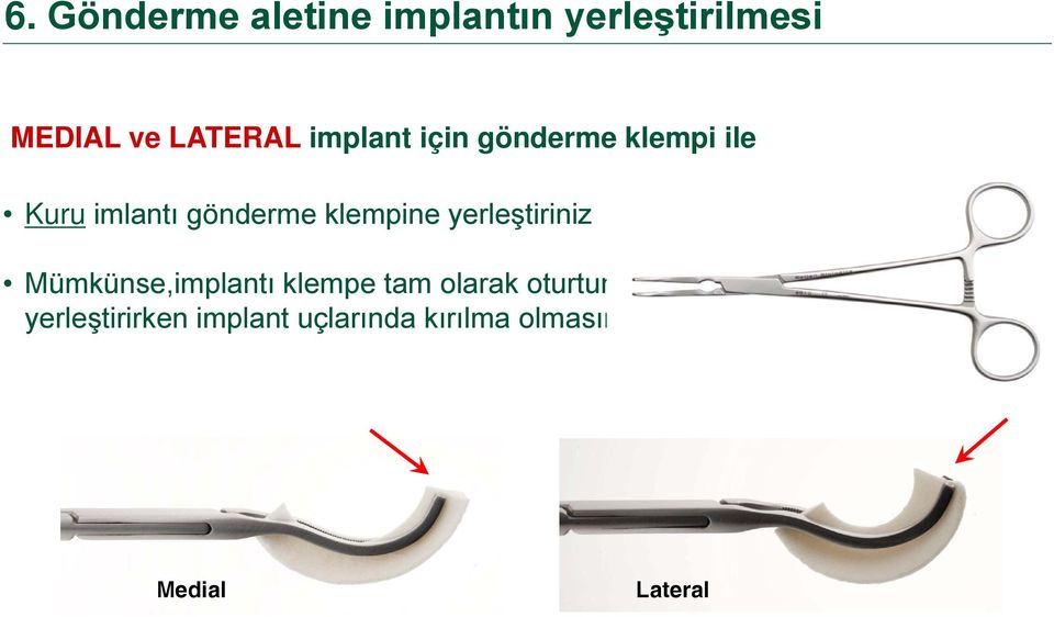 yerleştiriniz Mümkünse,implantı klempe tam olarak oturtunuz,ki