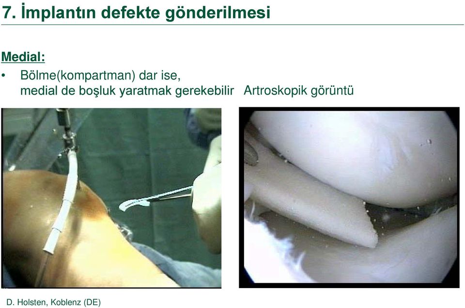 medial de boşluk yaratmak gerekebilir