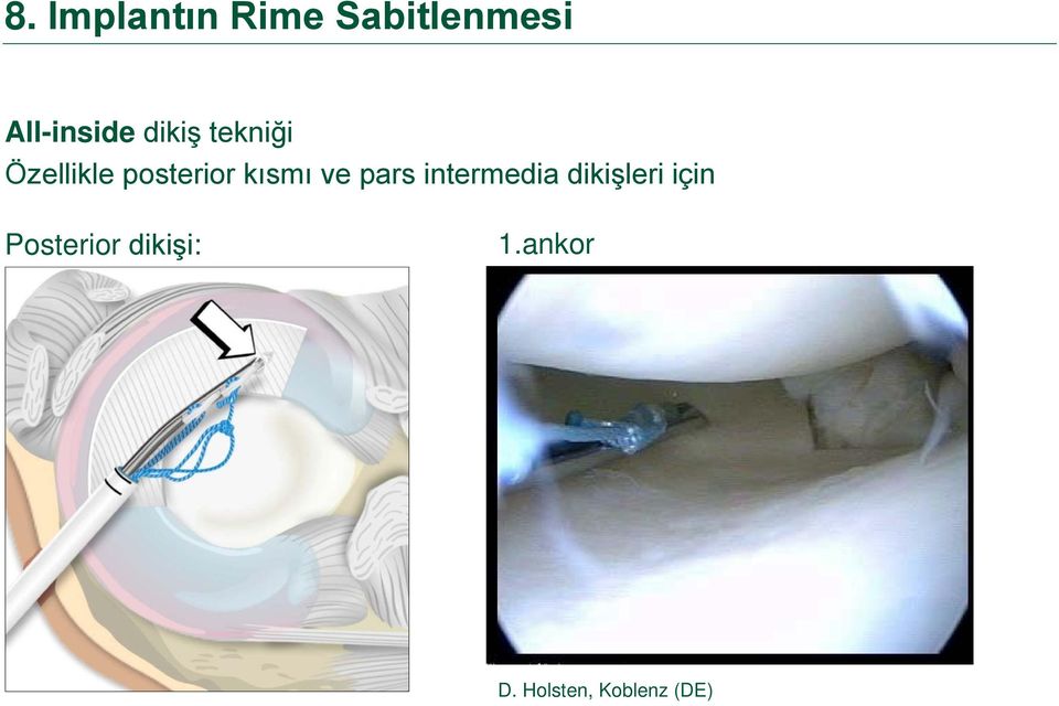 ve pars intermedia dikişleri için