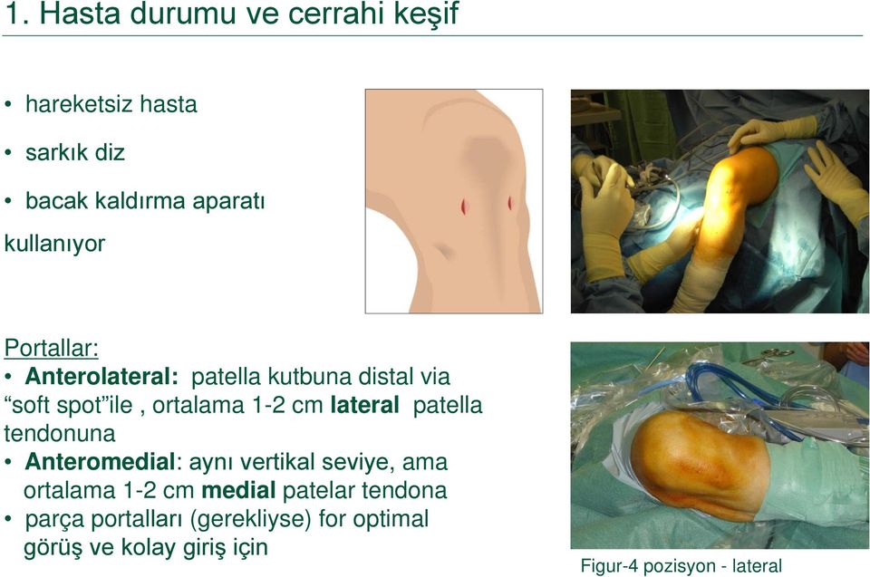 patella tendonuna Anteromedial: aynı vertikal seviye, ama ortalama 1-2 cm medial patelar