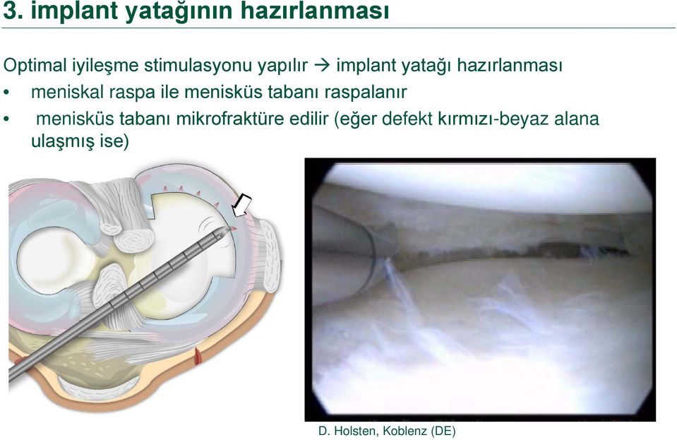 tabanı raspalanır menisküs tabanı mikrofraktüre edilir (eğer