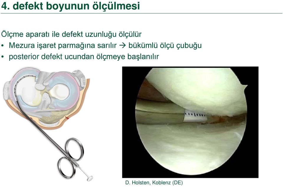 sarılır bükümlü ölçü çubuğu posterior defekt