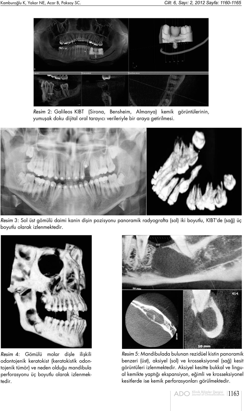 Resim 3: Sol üst gömülü daimi kanin dişin pozisyonu panoramik radyografta (sol) iki boyutlu, KIBT de (sağ) üç boyutlu olarak izlenmektedir.
