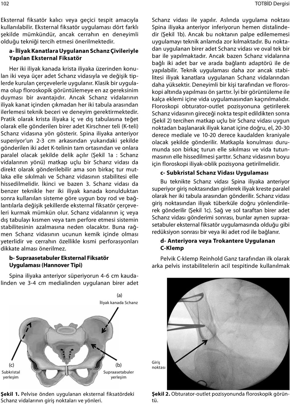 a- İliyak Kanatlara Uygulanan Schanz Çivileriyle Yapılan Eksternal Fiksatör Her iki iliyak kanada krista iliyaka üzerinden konulan iki veya üçer adet Schanz vidasıyla ve değişik tiplerde kurulan