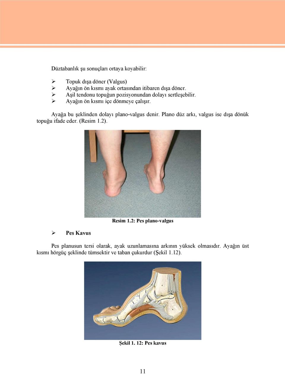 Ayağa bu şeklinden dolayı plano-valgus denir. Plano düz arkı, valgus ise dışa dönük topuğu ifade eder. (Resim 1.2). Pes Kavus Resim 1.