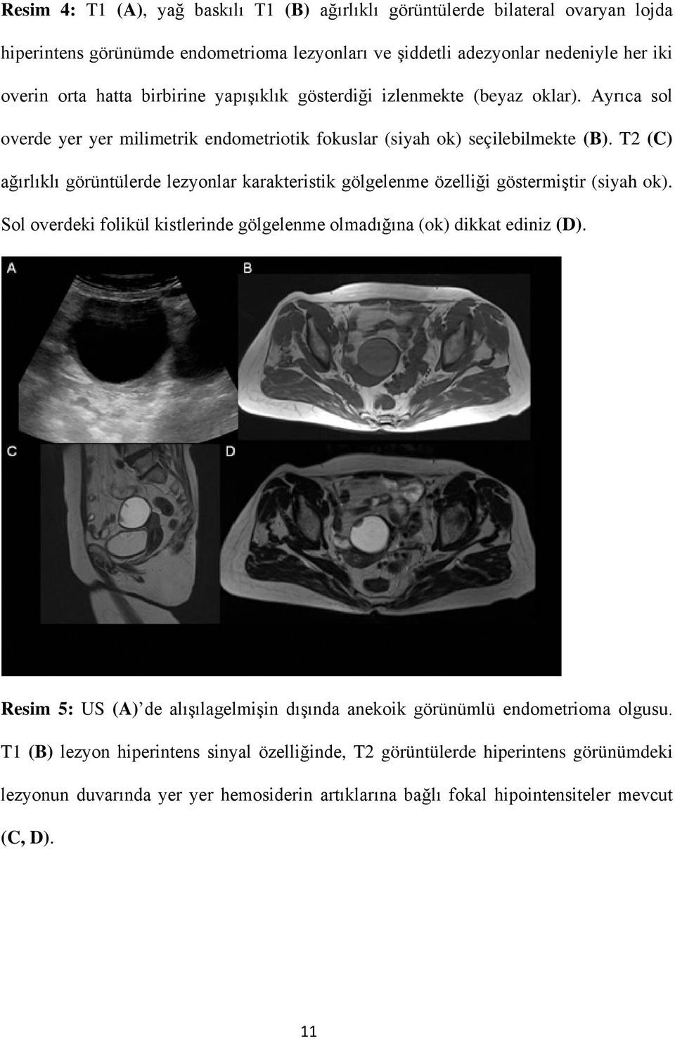 T2 (C) ağırlıklı görüntülerde lezyonlar karakteristik gölgelenme özelliği göstermiştir (siyah ok). Sol overdeki folikül kistlerinde gölgelenme olmadığına (ok) dikkat ediniz (D).