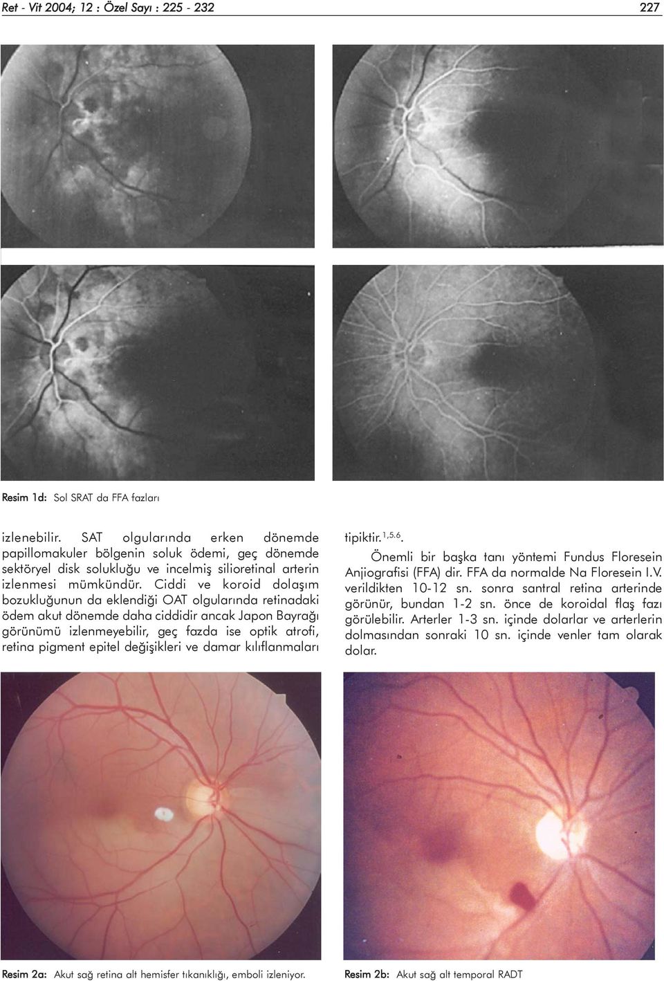 Ciddi ve koroid dolaþým bozukluðunun da eklendiði OAT olgularýnda retinadaki ödem akut dönemde daha ciddidir ancak Japon Bayraðý görünümü izlenmeyebilir, geç fazda ise optik atrofi, retina pigment