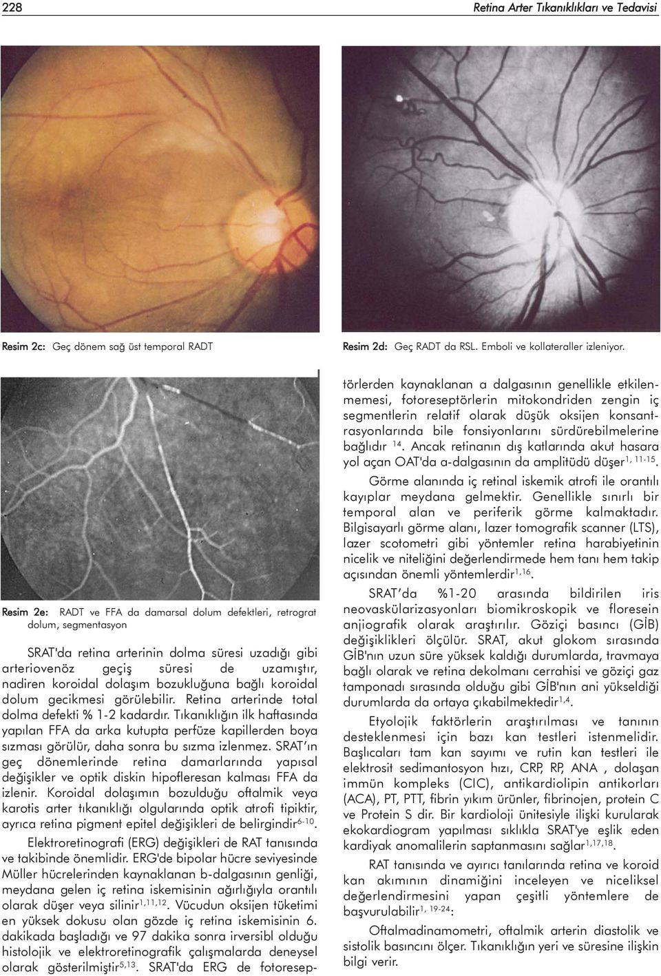 bozukluðuna baðlý koroidal dolum gecikmesi görülebilir. Retina arterinde total dolma defekti % 1-2 kadardýr.