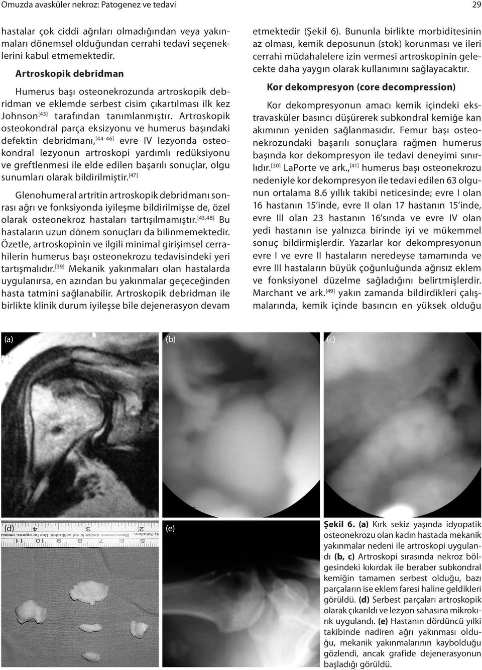 Artroskopik osteokondral parça eksizyonu ve humerus başındaki defektin debridmanı, [44-46] evre IV lezyonda osteokondral lezyonun artroskopi yardımlı redüksiyonu ve greftlenmesi ile elde edilen