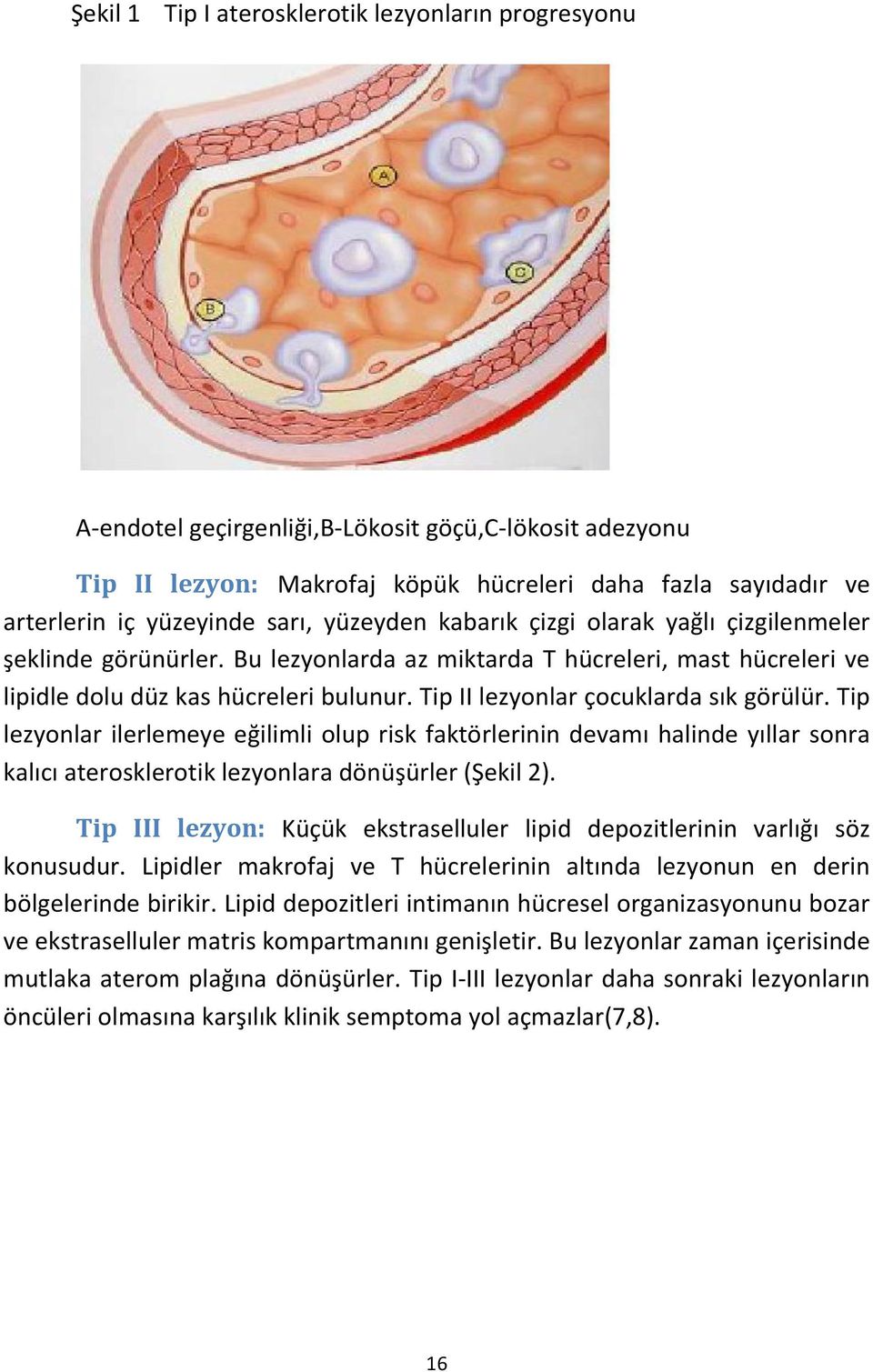 Tip II lezyonlar çocuklarda sık görülür. Tip lezyonlar ilerlemeye eğilimli olup risk faktörlerinin devamı halinde yıllar sonra kalıcı aterosklerotik lezyonlara dönüşürler (Şekil 2).