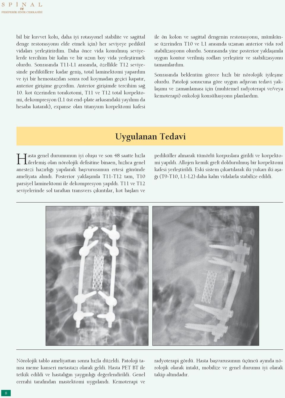 Sonrasında T11-L1 arasında, özellikle T12 seviyesinde pediküllere kadar geniş, total laminektomi yapardım ve iyi bir hemostazdan sonra rod koymadan geçici kapatır, anterior girişime geçerdim.