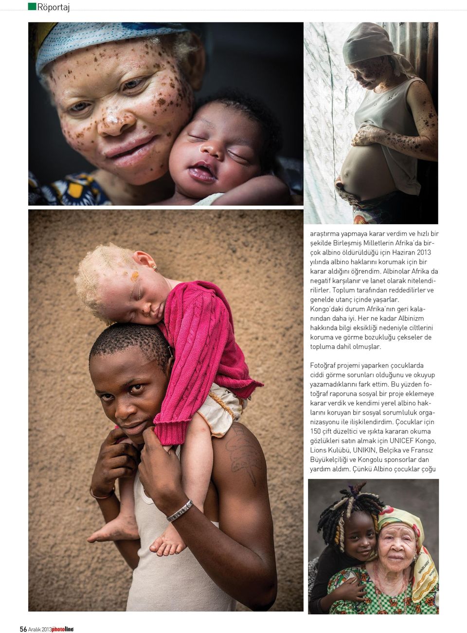 Kongo daki durum Afrika nın geri kalanından daha iyi. Her ne kadar Albinizm hakkında bilgi eksikliği nedeniyle ciltlerini koruma ve görme bozukluğu çekseler de topluma dahil olmuşlar.