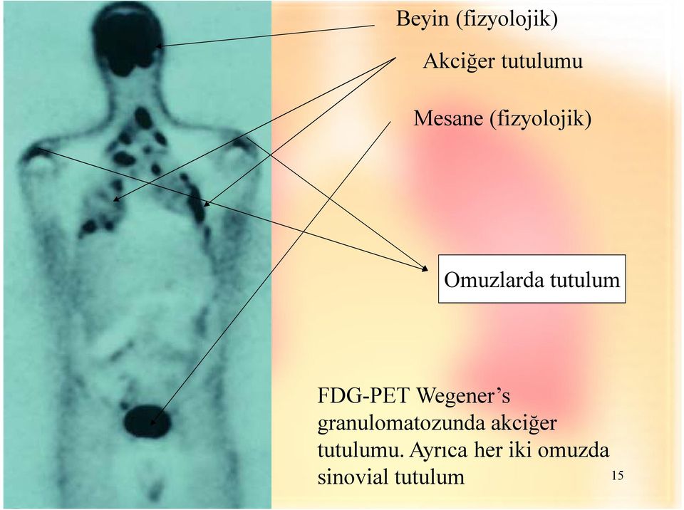 FDG-PET Wegener s granulomatozunda