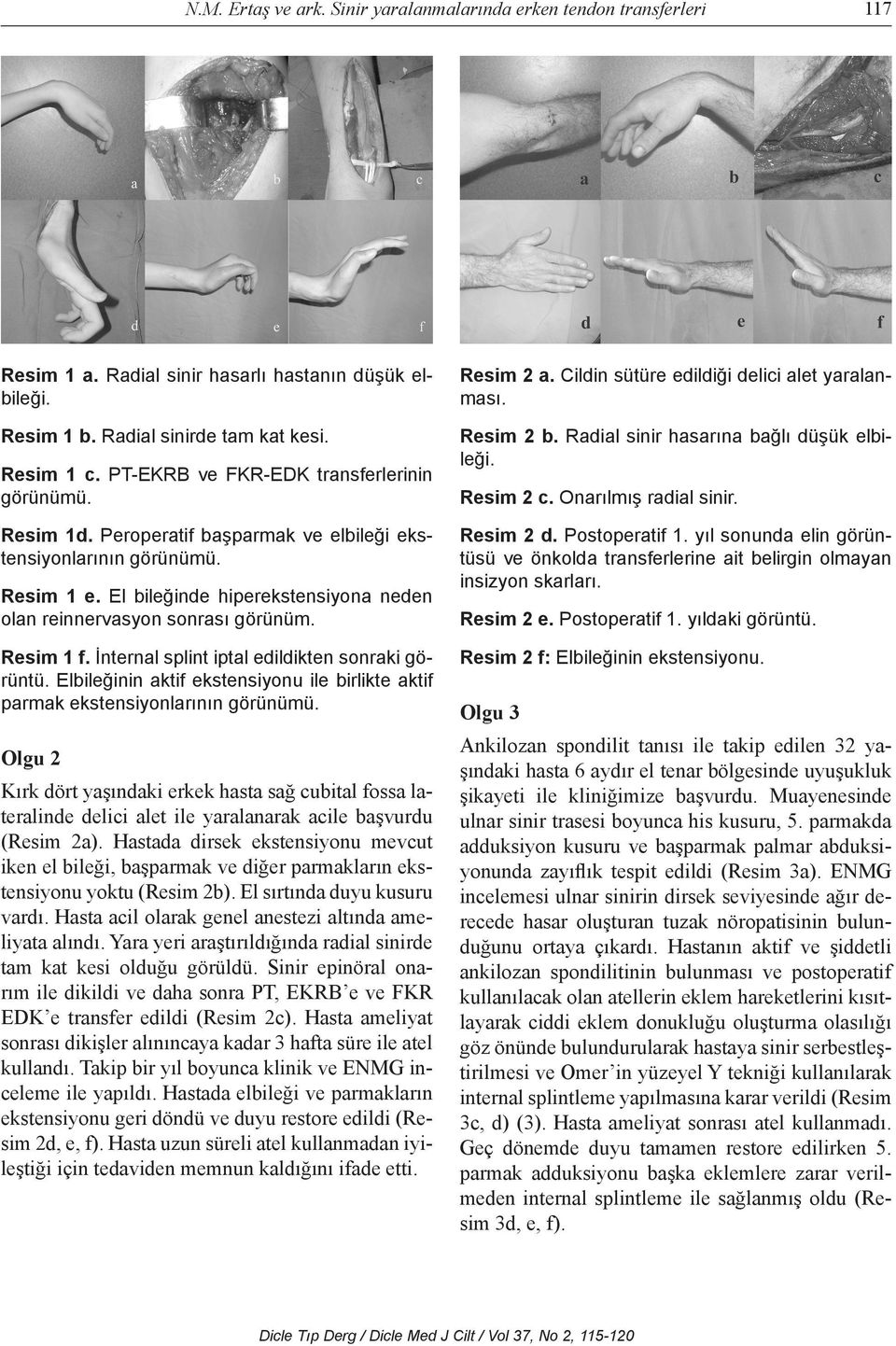 El bileğinde hiperekstensiyona neden olan reinnervasyon sonrası görünüm. Resim 1 f. İnternal splint iptal edildikten sonraki görüntü.