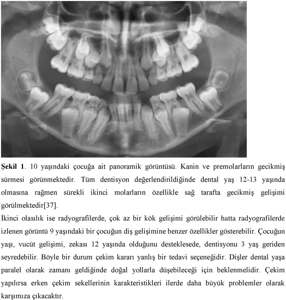 İkinci olasılık ise radyografilerde, çok az bir kök gelişimi görülebilir hatta radyografilerde izlenen görüntü 9 yaşındaki bir çocuğun diş gelişimine benzer özellikler gösterebilir.
